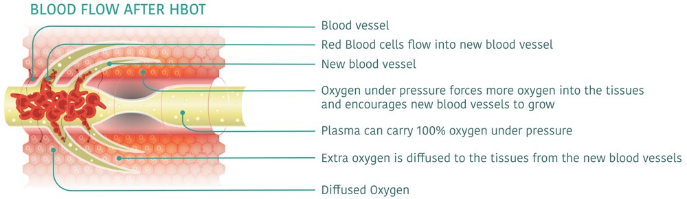 Blood Flow After Hyperbaric Oxygen Therapy (HBOT) | Renewal Care Wellness Center | Beaverton, Oregon