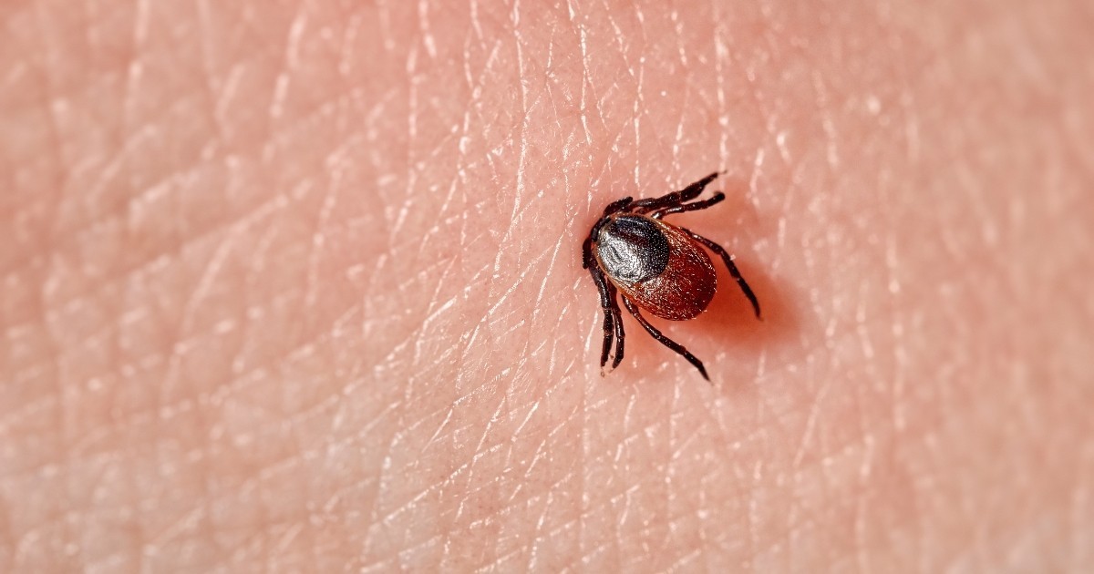 Hyperbaric Oxygen Therapy and Lyme Disease | Tick Embedded into Skin